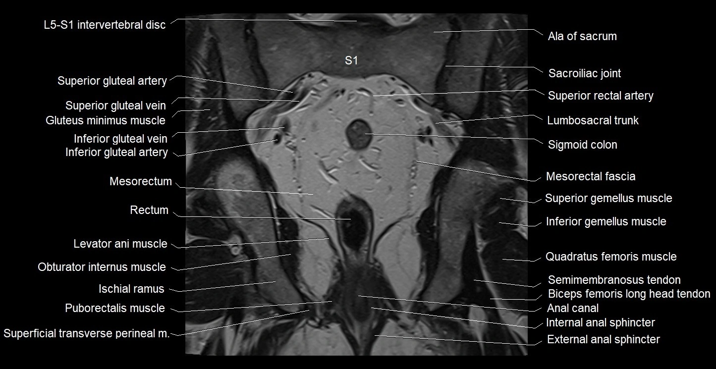 MRI coronal cross sectional anatomy male pelvis image 27.webp